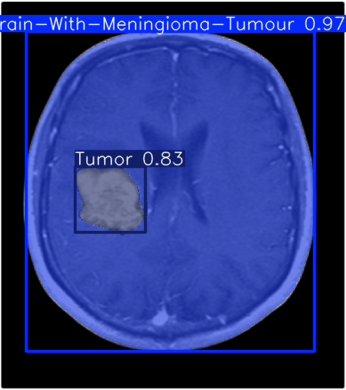 Brain Tumor Detection