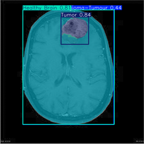 Brain Tumor Segmentation Output